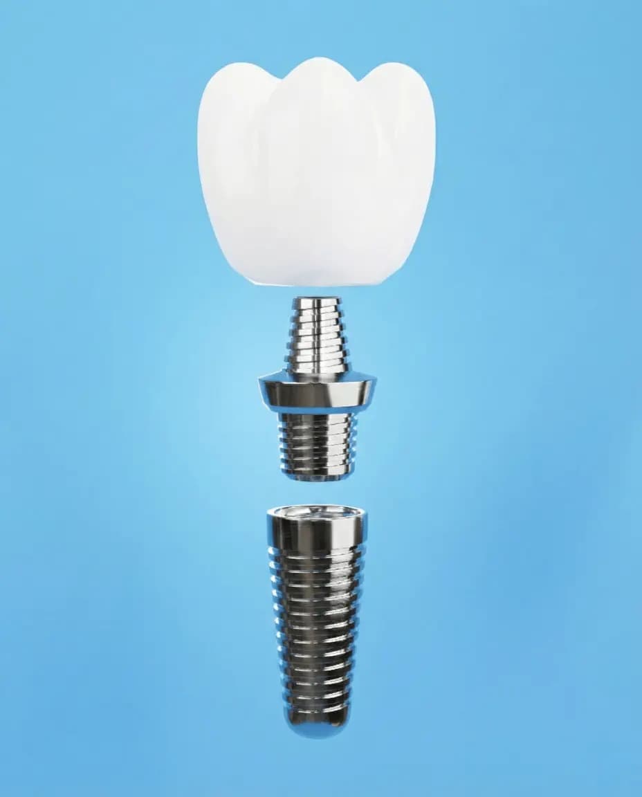 Implants Complets