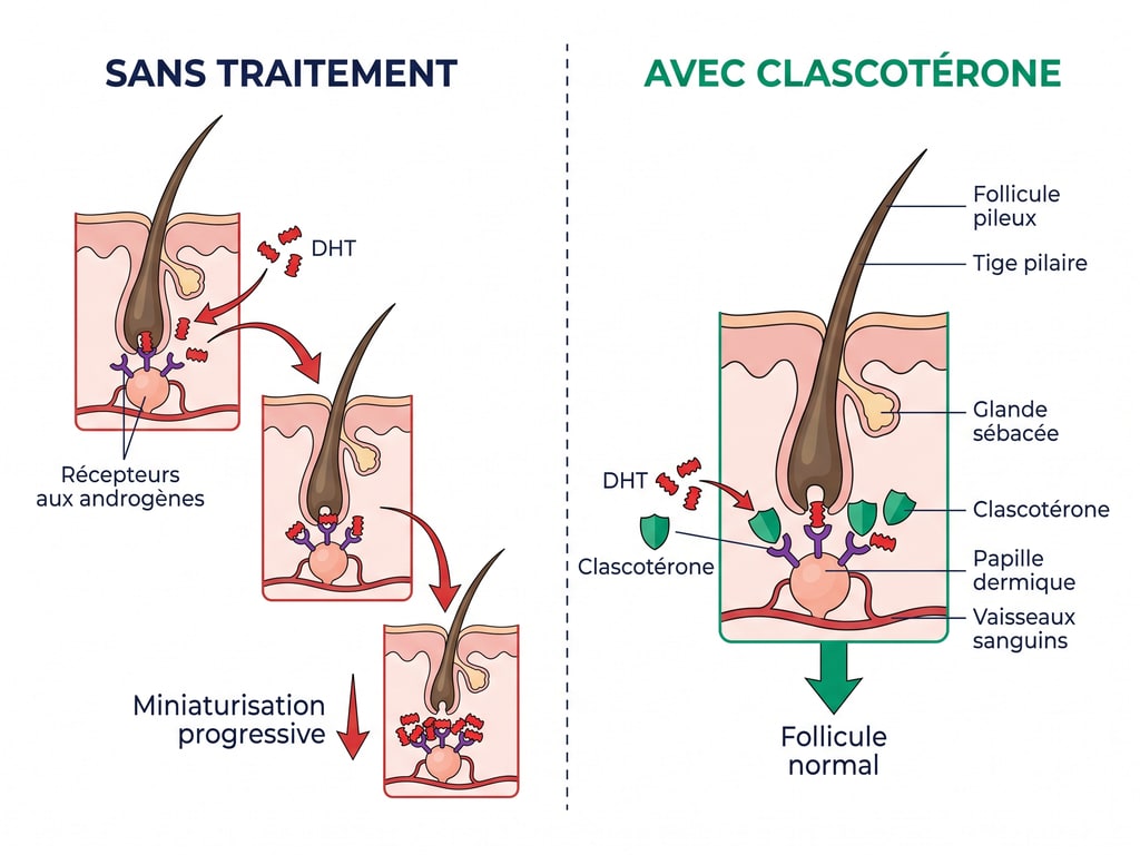 Schéma du mécanisme d'action du clascotérone bloquant la liaison de la DHT au récepteur androgénique