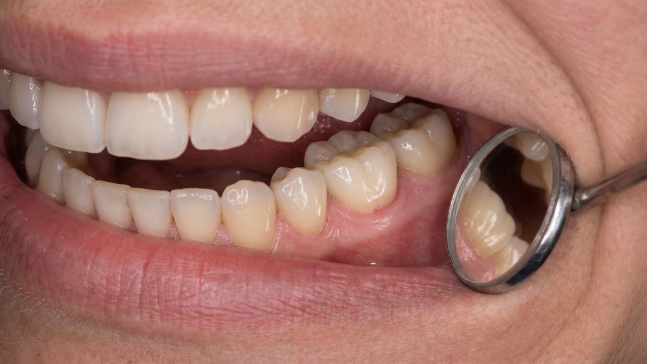 Résultat clinique d'une reprise endodontique molaire avec couronne E.max céramique à Renaissance Clinique