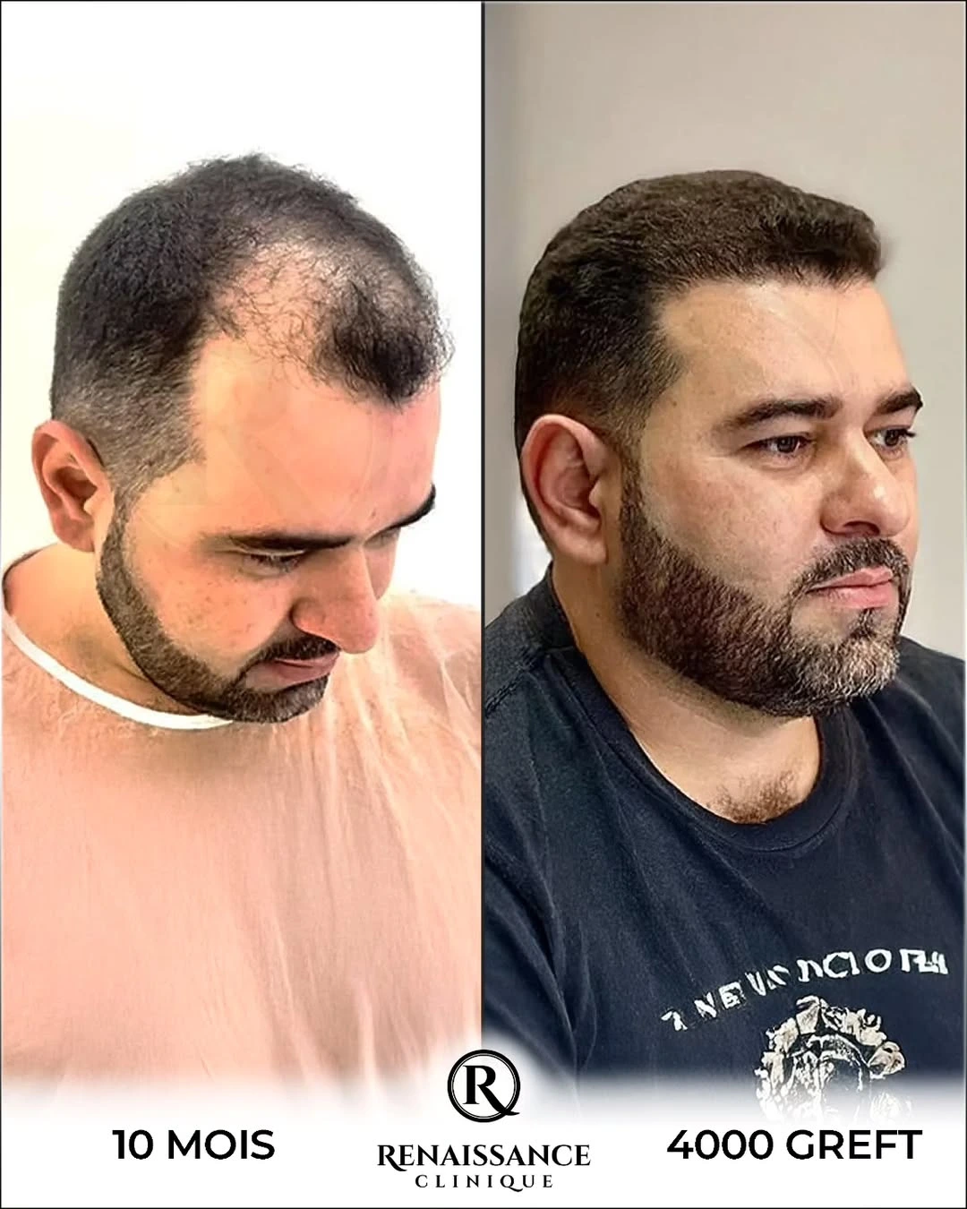 Résultat greffe de cheveux FUE Saphir Choi Pen Istanbul - 4000 greffons - 10 mois après - Densification vertex - Patient belge - Renaissance Clinique Turquie