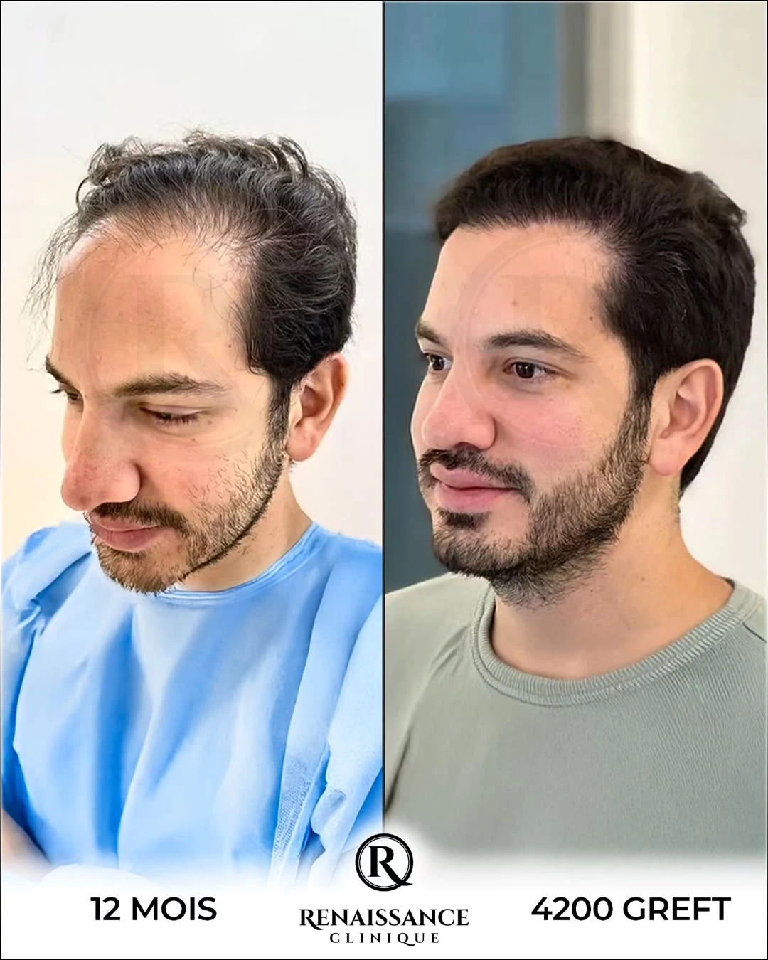 Résultat greffe de cheveux FUE Saphir Choi Pen Istanbul - 4200 greffons - 12 mois après - Patient marocain Casablanca - Renaissance Clinique Turquie