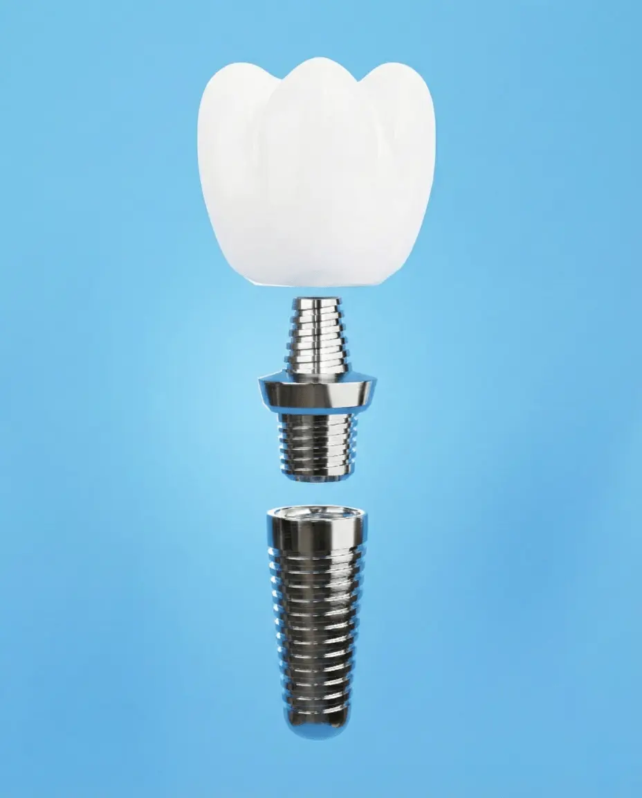 Implants Dentaires