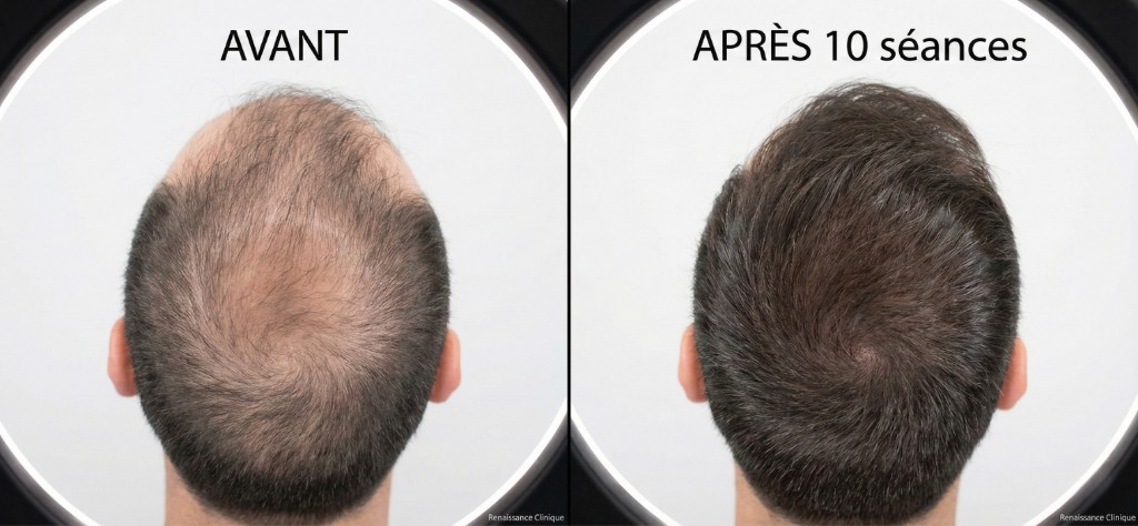Résultat avant/après mésothérapie capillaire — 10 séances, amélioration de la densité du vertex | Renaissance Clinique Istanbul Résultat avant/après mésothérapie capillaire sur le vertex (sommet du crâne) d'un patient masculin : à gauche (AVANT) — vue plongeante montrant un amincissement capillaire diffus avec cuir chevelu largement visible à travers des cheveux clairsemés, fins et sans volume ; à droite (APRÈS 10 séances) — même angle et même patient montrant une densité capillaire nettement améliorée, cheveux plus épais et plus denses, cuir chevelu beaucoup moins visible, volume et couverture restaurés. Photos prises sous éclairage clinique identique (ring light), fond noir, watermark Renaissance Clinique