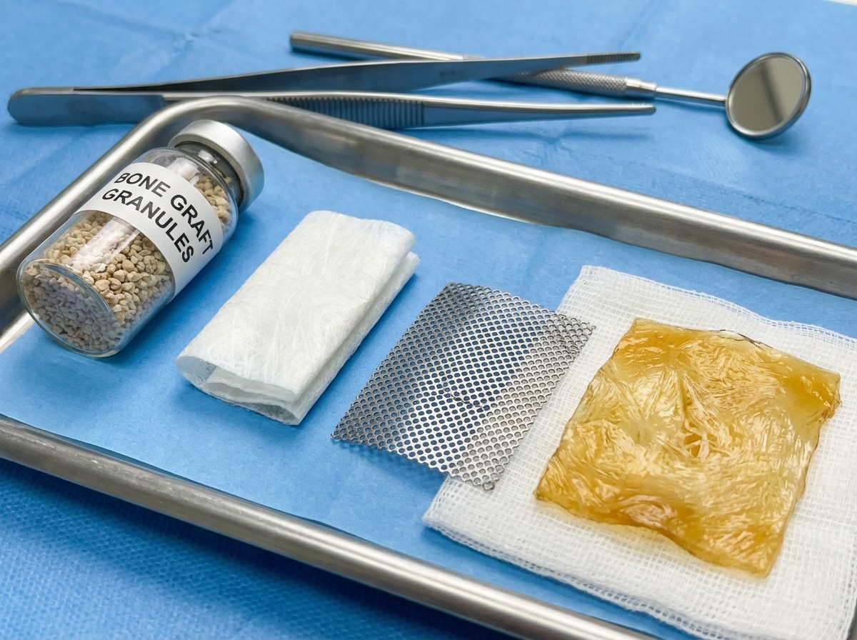 Biomatériaux pour greffe osseuse dentaire : Bio-Oss, os autogène et membrane collagène